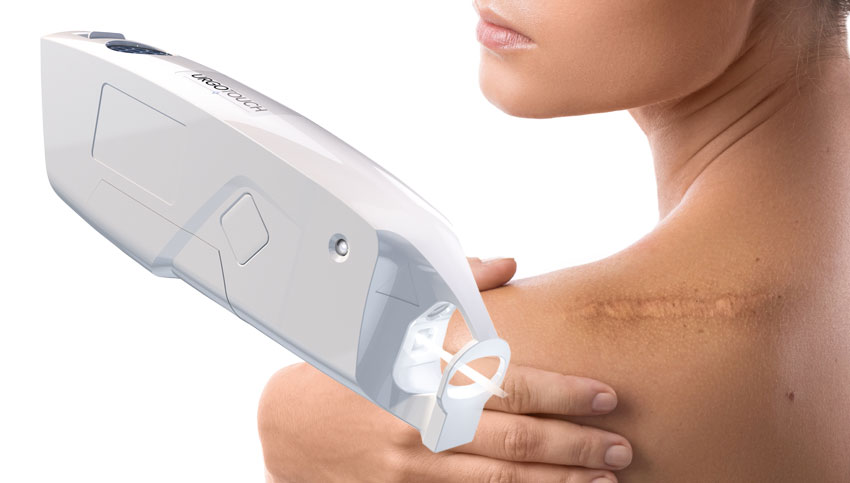 Urgo Touch: la tecnología láser revolucionaria para obtener mejores resultados en las cicatrices quirúrgicas